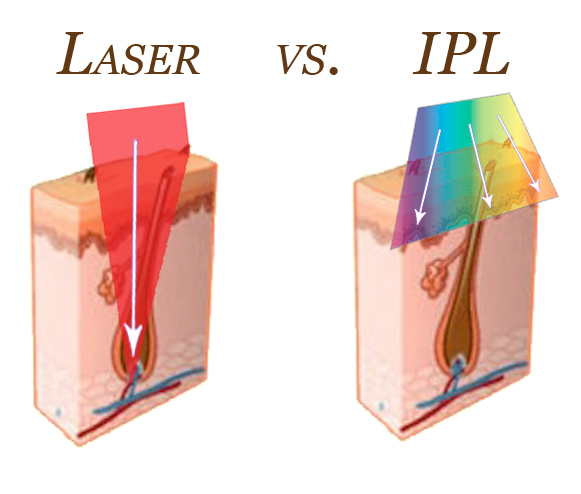 لیزر موهای زائد IPL